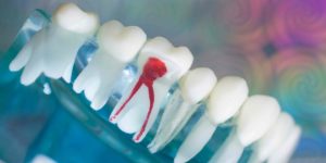 Эндодонтия в стоматологии: что это такое, показания для лечения